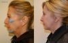 Left Facial Implant w/Sizers