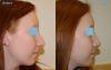 Rhinoplasty 2 - lateral view