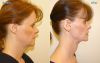 Neck Liposuction and Lift