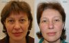 Blepharoplasty