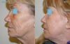 Laser Skin Rejuvenation - lateral view