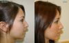 Rhinoplasty 3 - lateral view