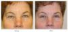 Blepharoplasty