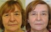 Browlift and Blepharoplasty