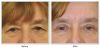 Blepharoplasty