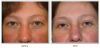 Blepharoplasty